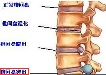 椎间盘突出
