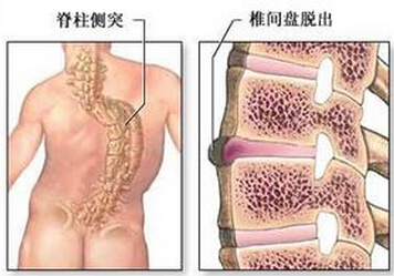 小儿先天性脊柱畸形