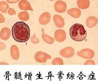 骨髓增生异常综合征