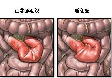 肠梗阻