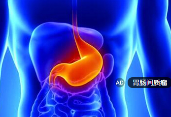 胃肠间质瘤