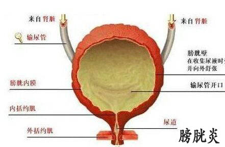 膀胱炎