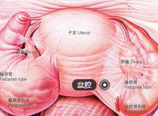 盆腔炎性包块