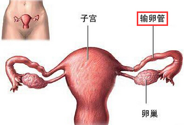 输卵管迂曲梗阻