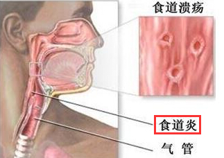 食道炎