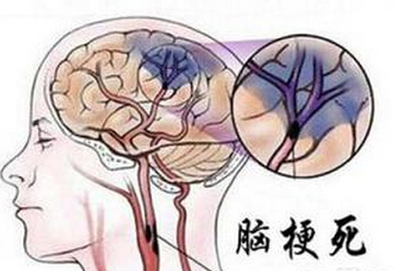 急性脑梗死
