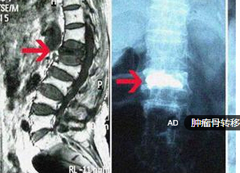 脑骨瘤转移