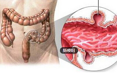 肠梗阻