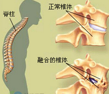 强脊炎