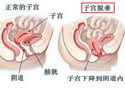 子宫脱垂