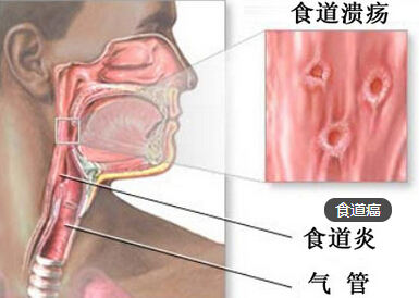 食道癌