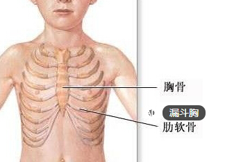 漏斗胸