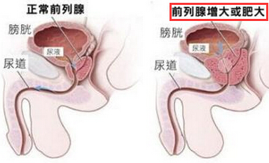 前列腺增生