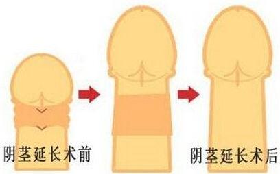 阴茎延长