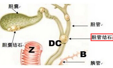 肝内胆管结石