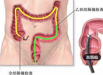 直肠癌