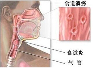 食管炎