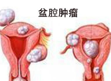 盆腔肿瘤