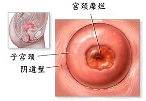 宫颈糜烂