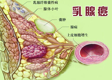 乳腺癌