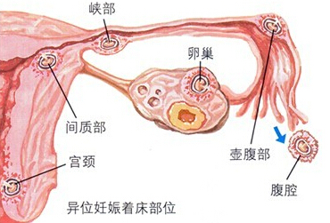 输卵管水肿上举