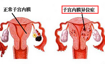 子宫内膜异位症