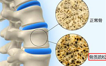 骨质疏松