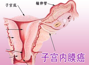 子宫内膜癌