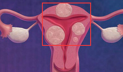弥漫性子宫腺肌症
