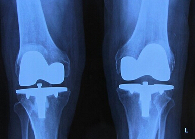 膝关节置换术