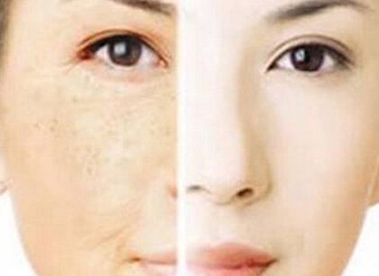 皮肤黑变病