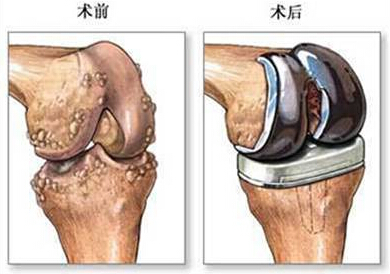 膝关节置换术