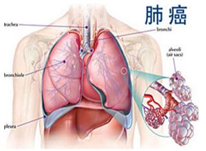 　肺癌