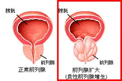 前列腺肥大