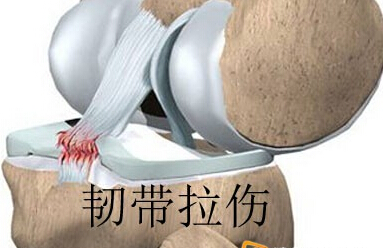 韧带拉伤