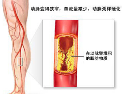 下肢动脉硬化闭塞症