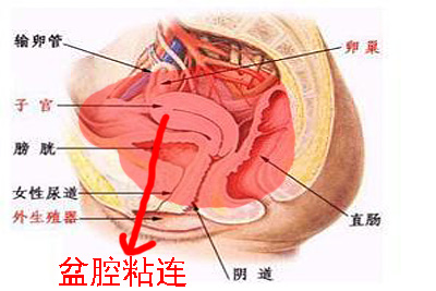 盆腔粘连