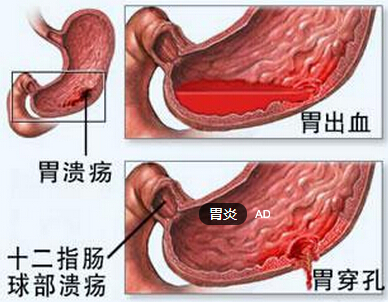胃炎