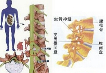 强直性脊柱