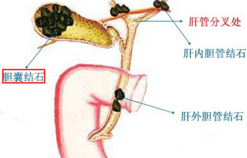 胆囊结石