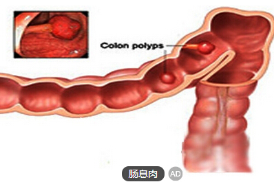 肠息肉