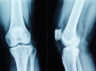 骨刺治疗