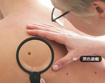 黑色素瘤