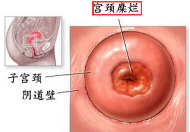 宫颈糜烂