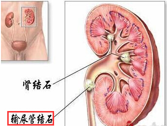输尿管结石