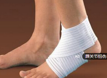 踝扭伤浮肿