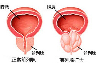 前列腺