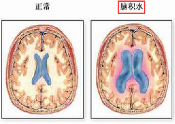 脑积水