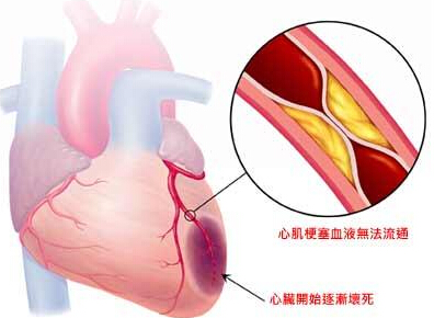 心肌梗塞