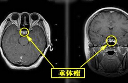 垂体瘤